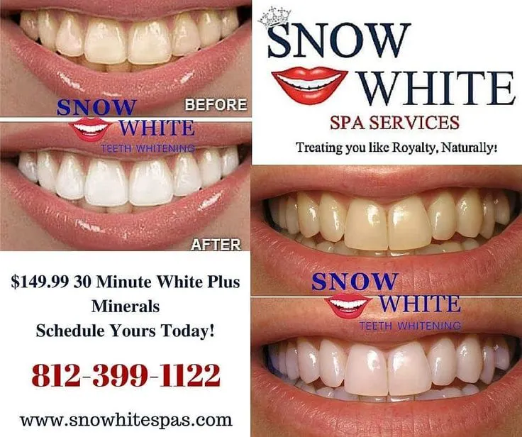 33365 teeth whitening consultation