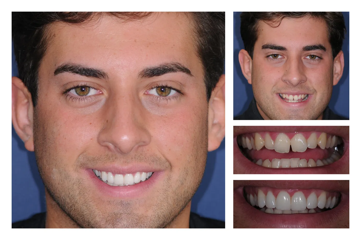 33368 teeth whitening convenience