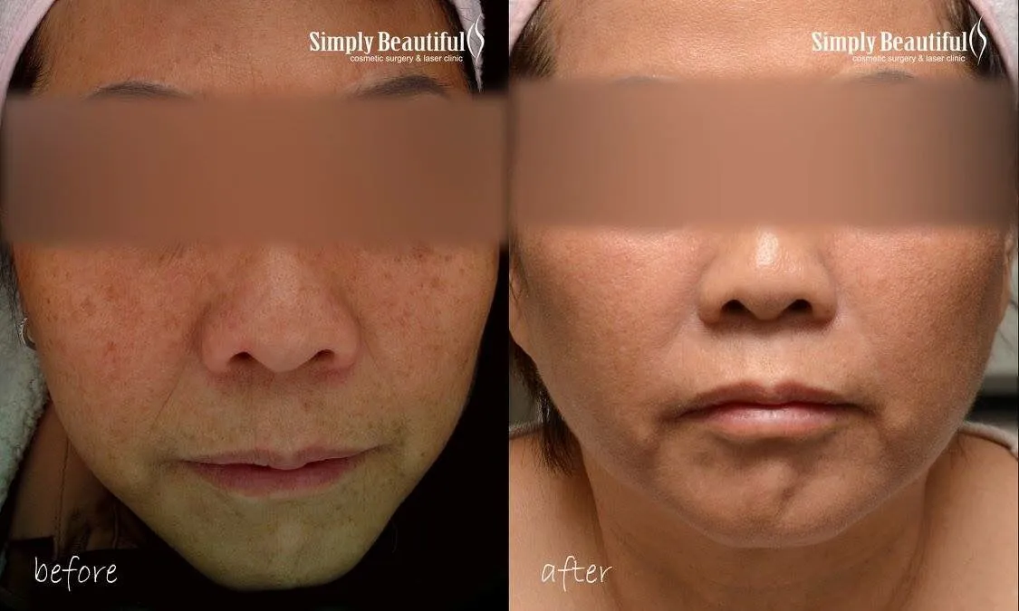 33378 collagen production laser