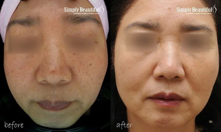 33378 skin texture improvement