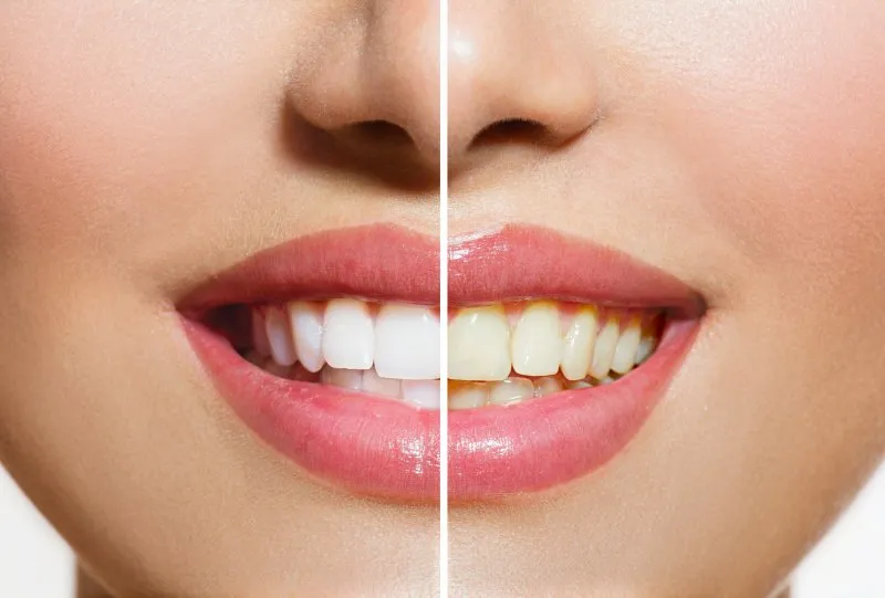 33385 myrtle beach teeth whitening dentist