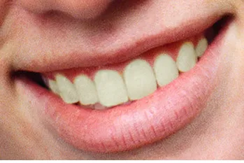 33394 teeth whitening fredericksburg va image2