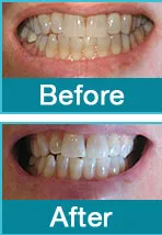 33394 teeth whitening fredericksburg va image3