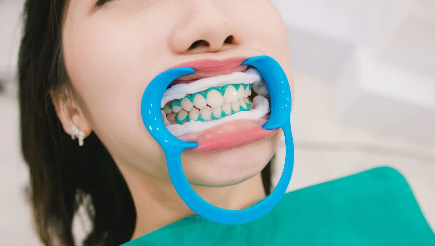 33394 teeth whitening fredericksburg va image6