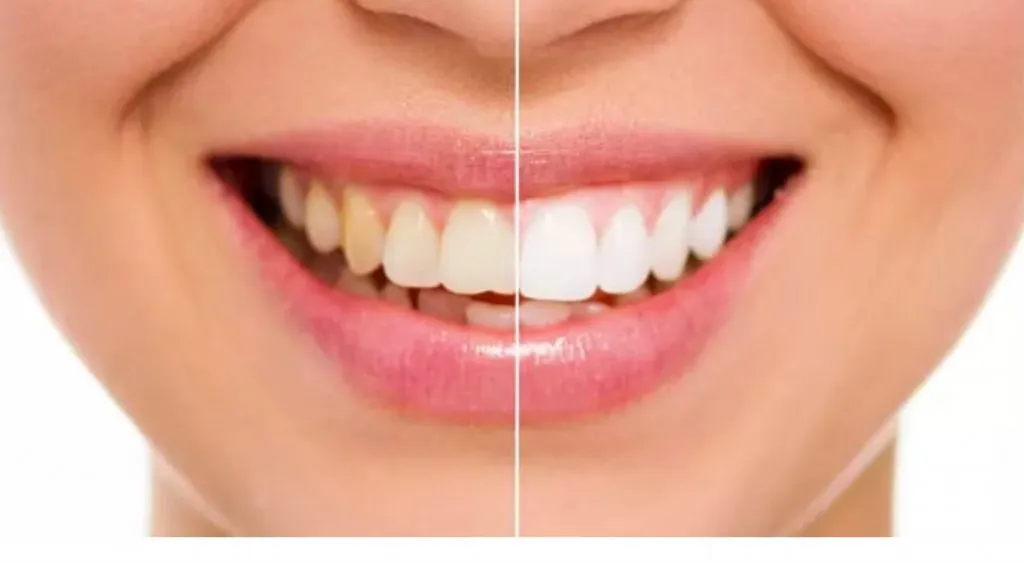 33394 teeth whitening fredericksburg va image7