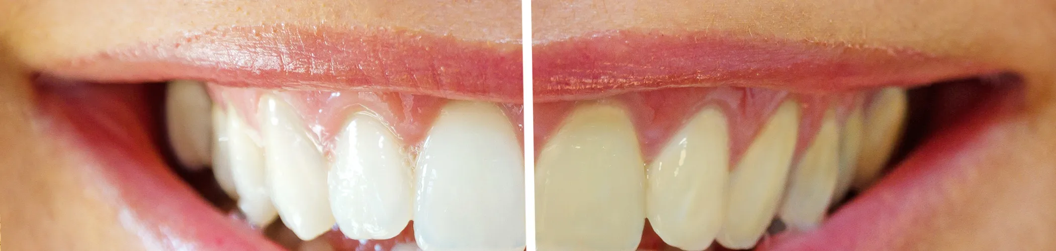 33395 whitening strips tooth pain 1