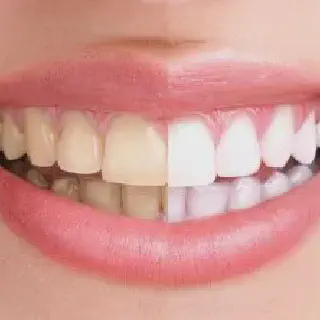 /img/33401-professional-teeth-whitening.webp