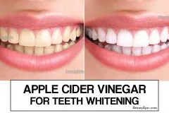33401 teeth whitening alternatives