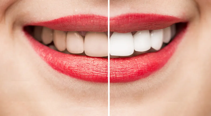 33401 teeth whitening science