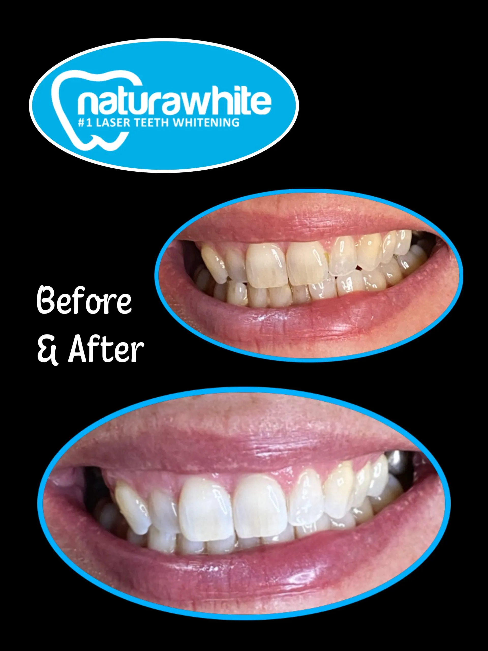 33414 at home teeth whitening