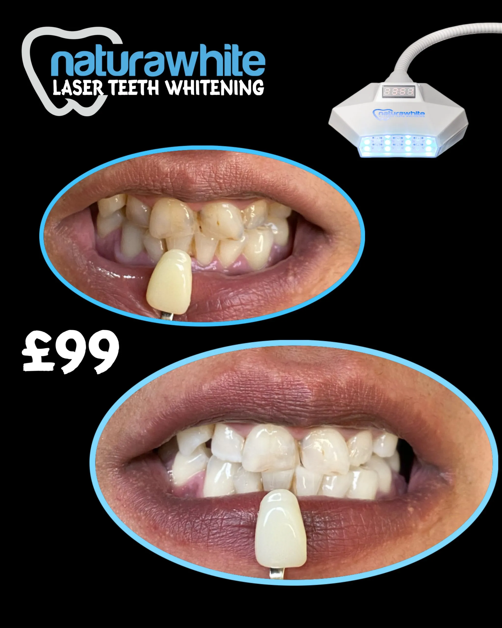 33414 in office teeth whitening