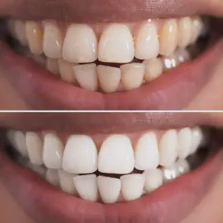 /img/33414-teeth-whitening-comparison.webp