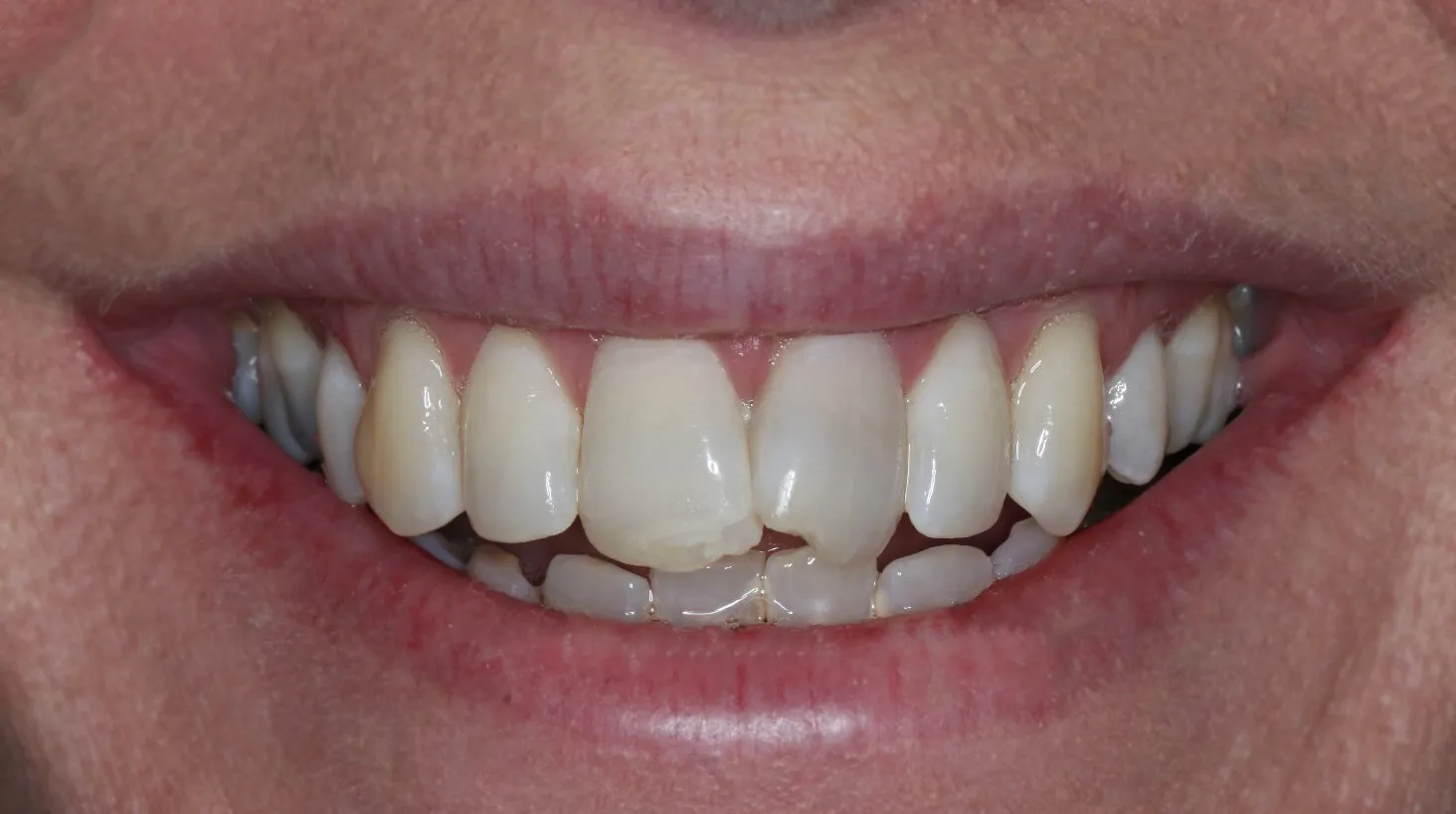 33414 teeth whitening results