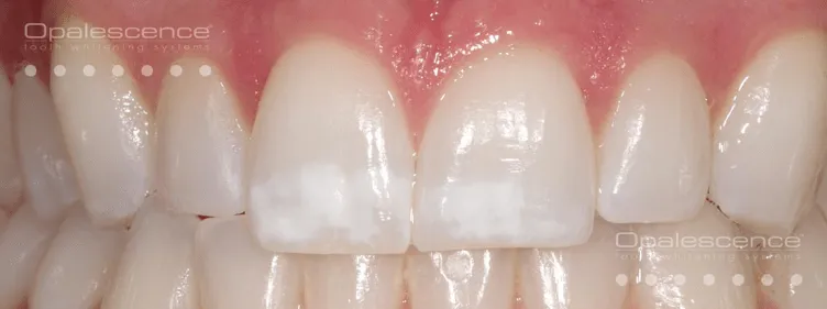 33423 gum irritation