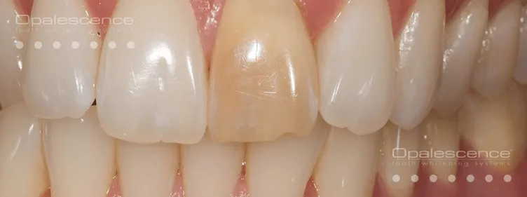 33423 sensitive teeth