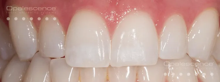 33423 white spots teeth