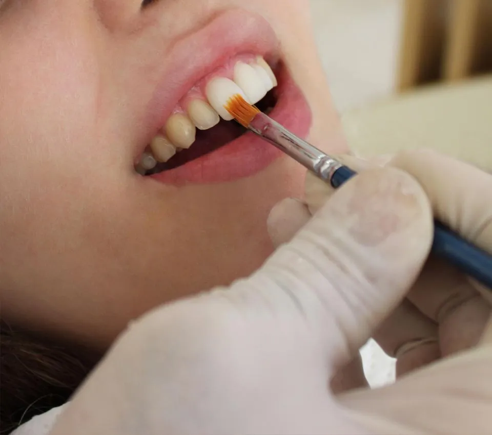 33426 composite veneers