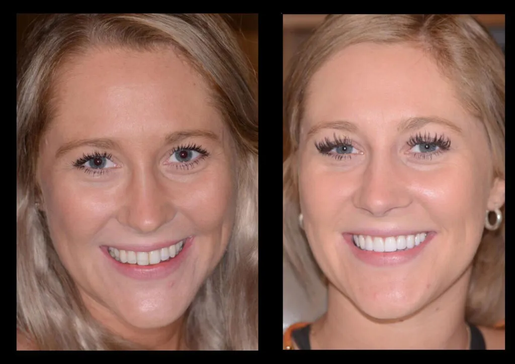 33426 teeth whitening results