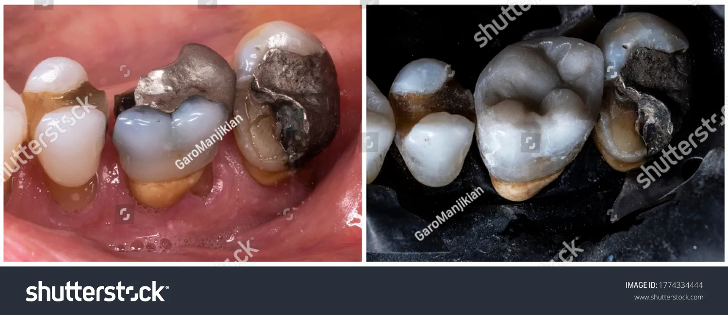 33429 teeth whitening guide