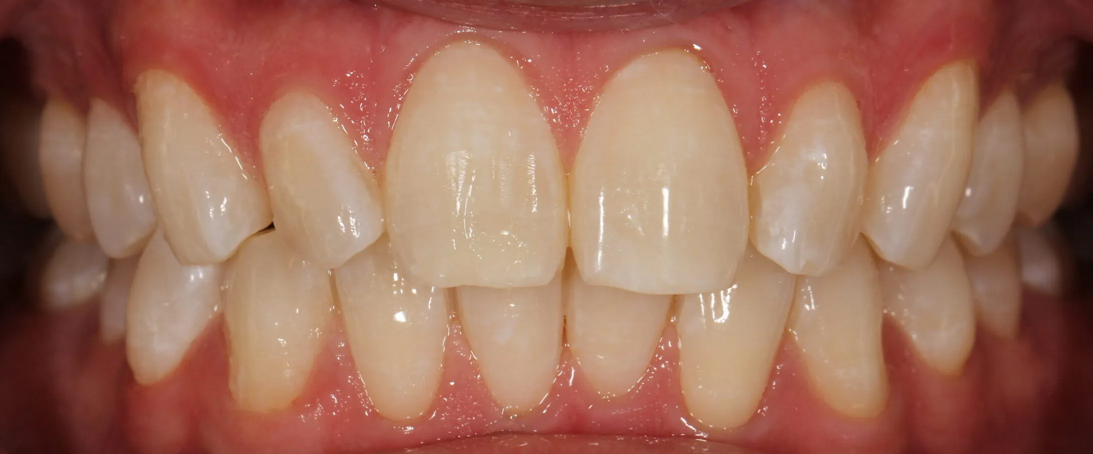 33431 dietary habits teeth whitening