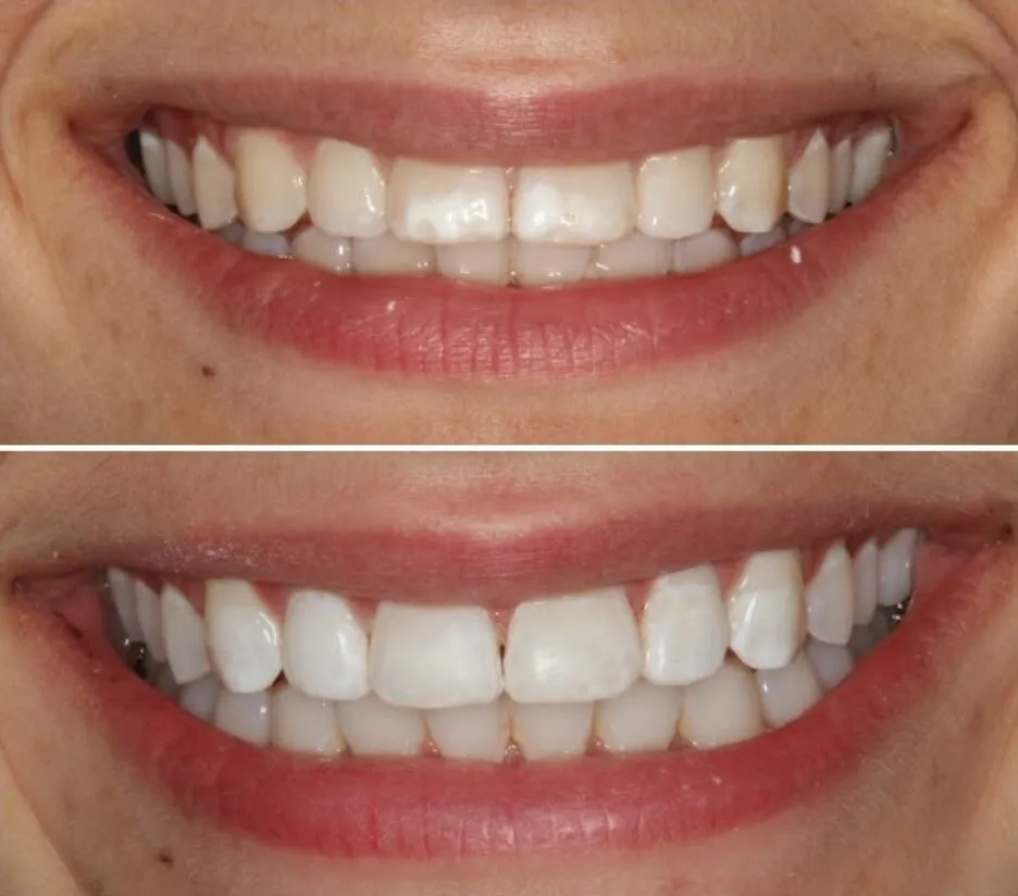 33434 teeth whitening columbia mo home kit