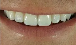 33434 teeth whitening columbia mo smile