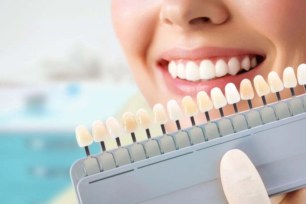 33439 in office teeth whitening