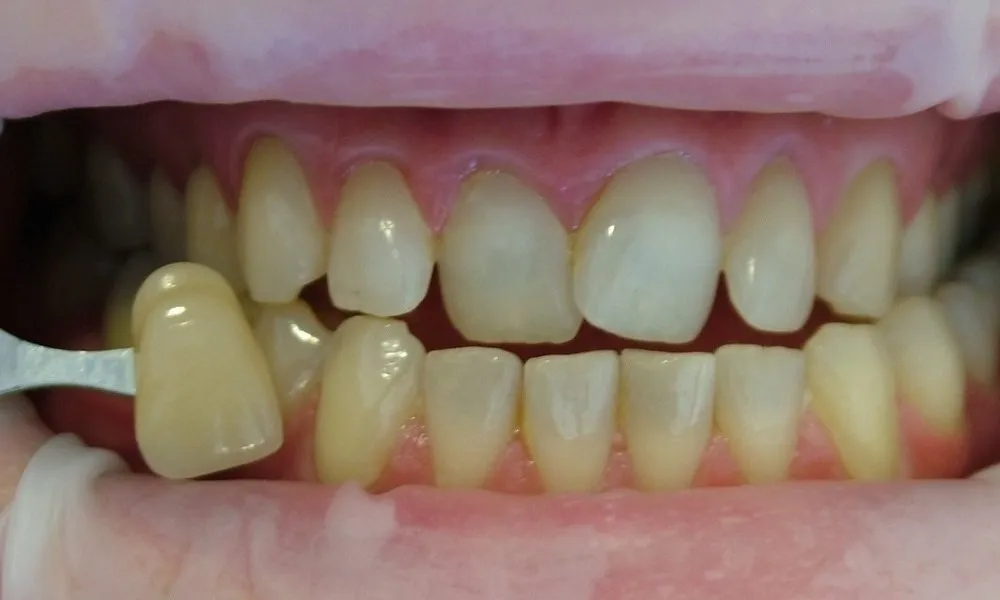 33439 teeth whitening aftercare