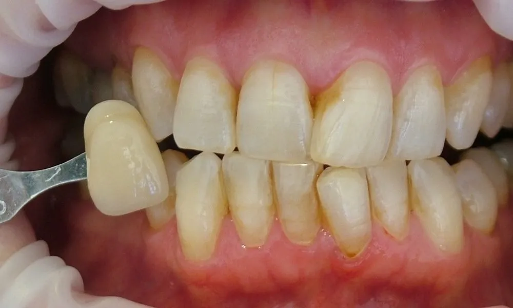 33439 teeth whitening results