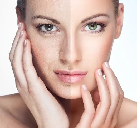 33441 face whitening before after