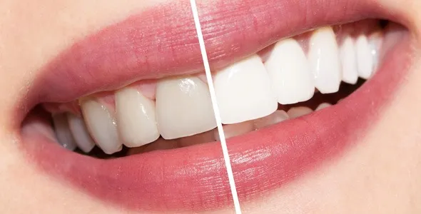 33463 professional teeth whitening