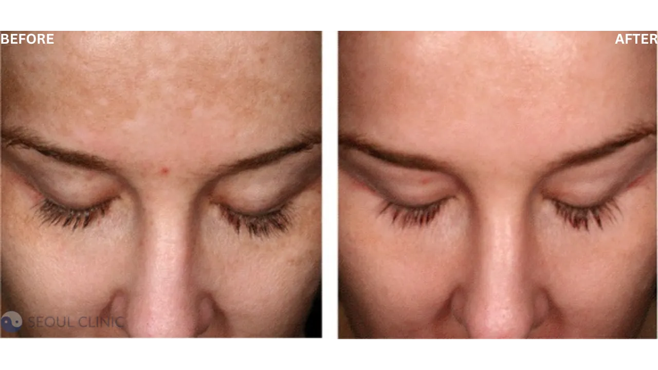 33479 dermal fillers