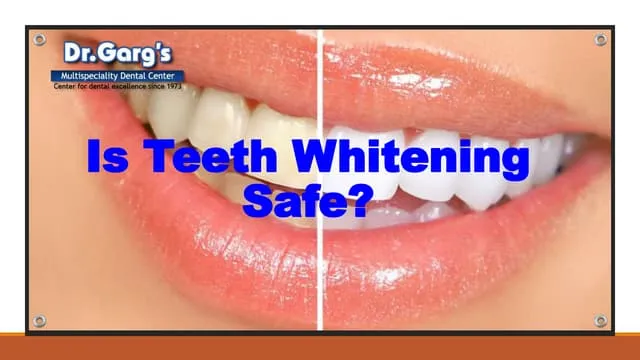 33484 professional teeth whitening
