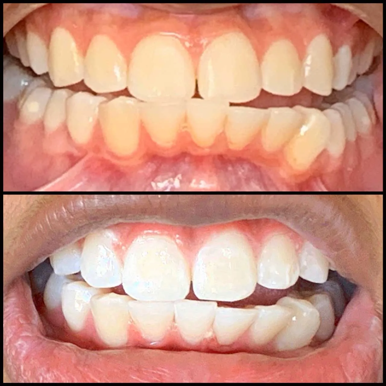 33504 teeth whitening new rochelle procedure