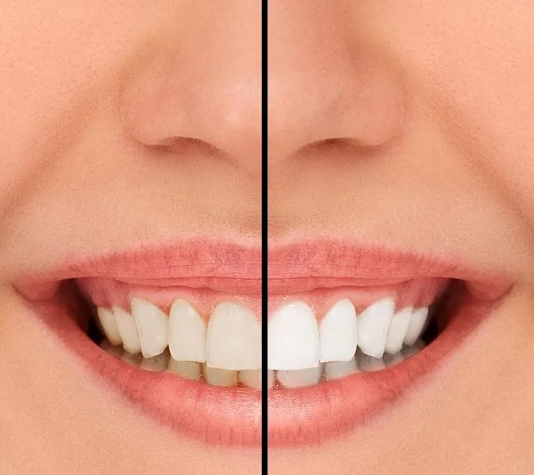 33506 teeth whitening chico ca image2