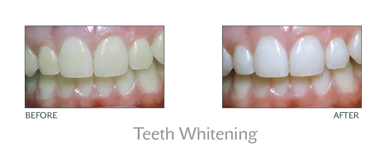 33507 in office teeth whitening