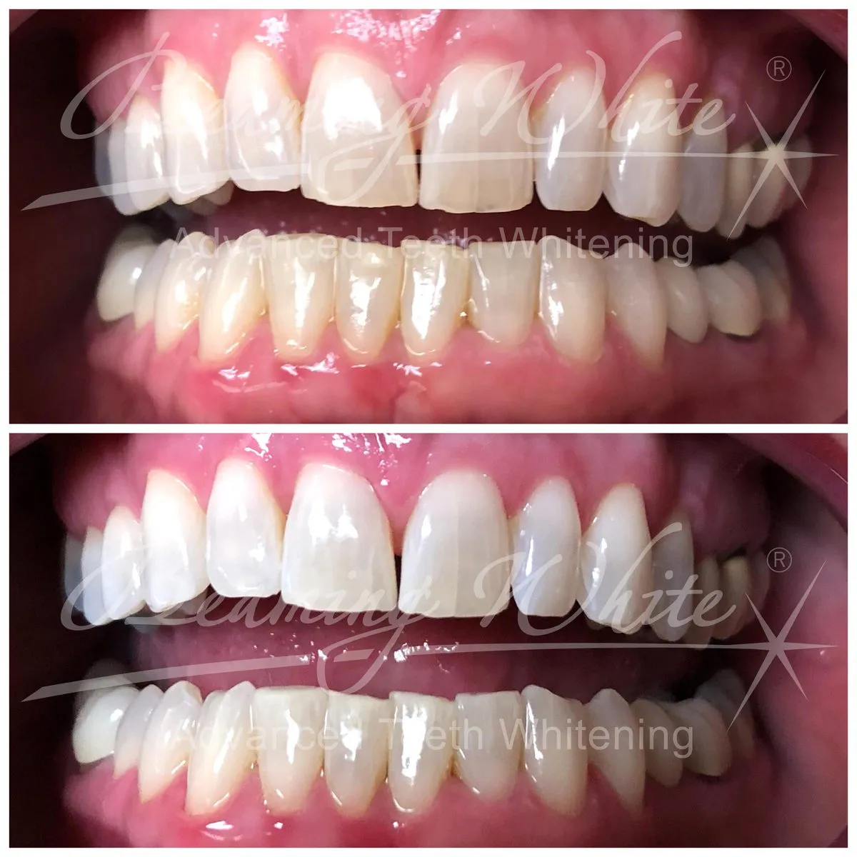 33513 at home teeth whitening