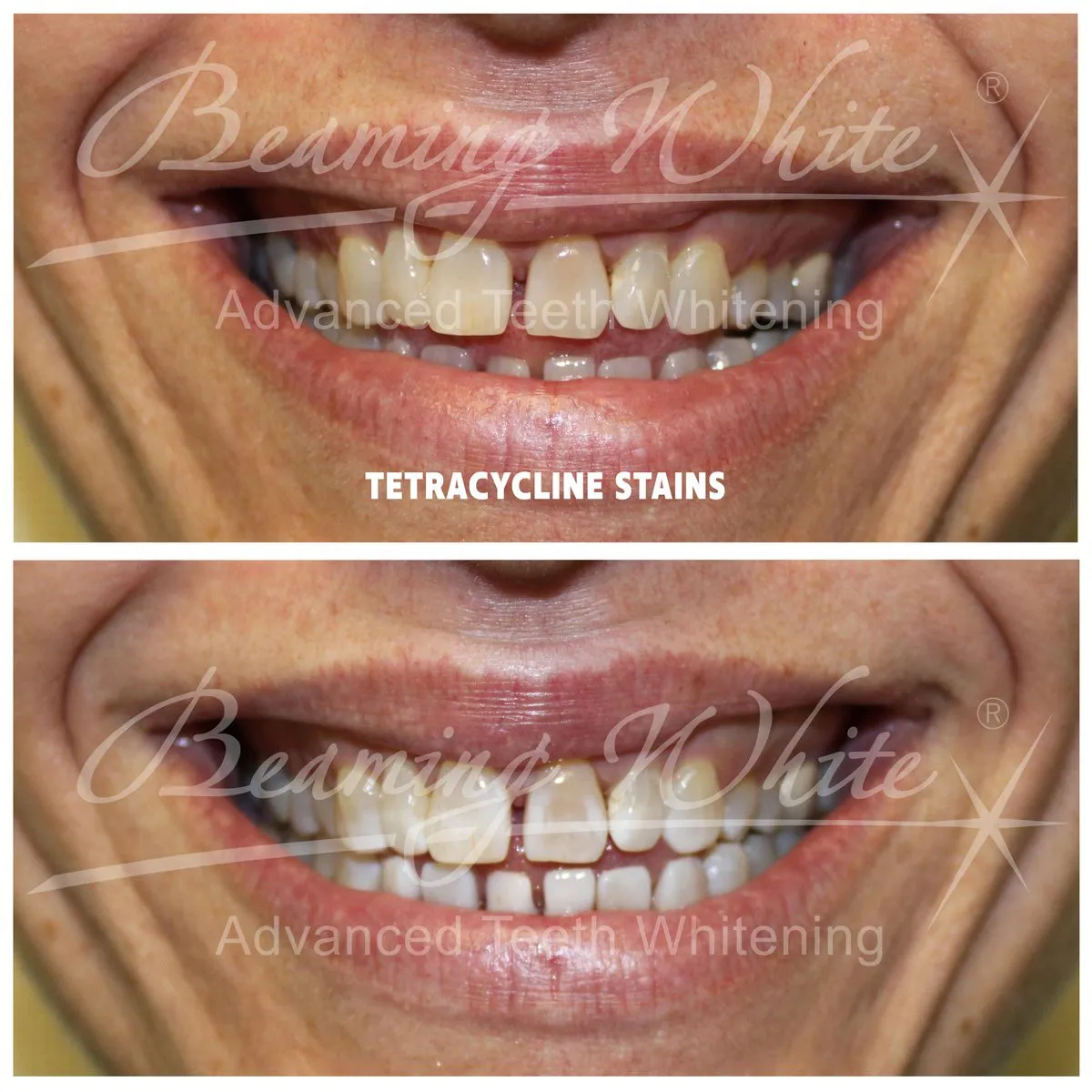 33513 hydrogen peroxide teeth whitening