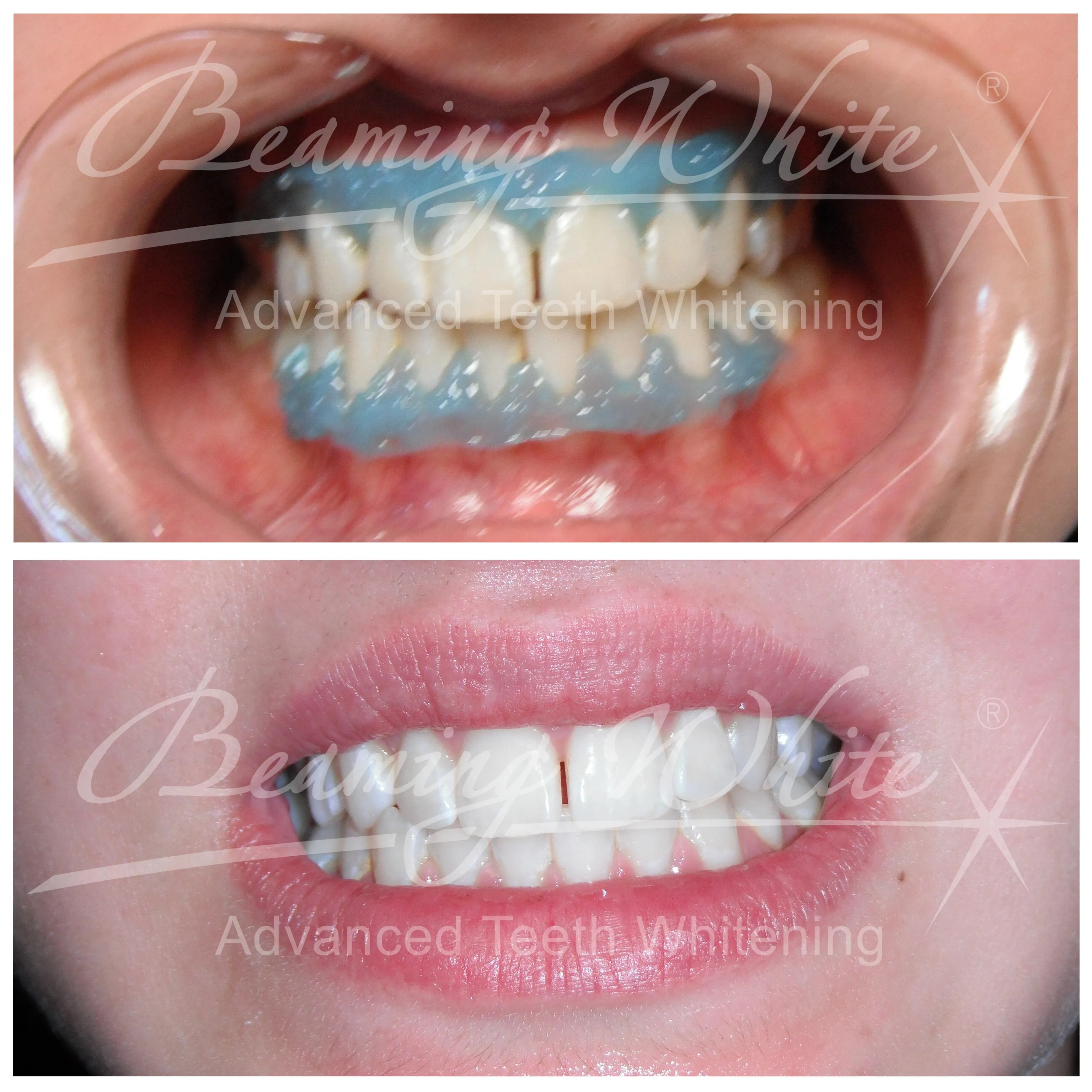 33513 professional teeth whitening
