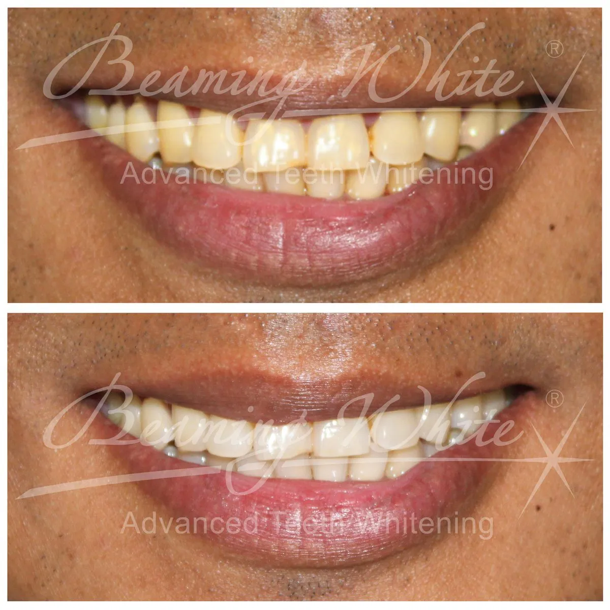 /img/33513-realistic-teeth-whitening.webp