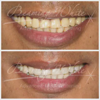 /img/33513-realistic-teeth-whitening.webp