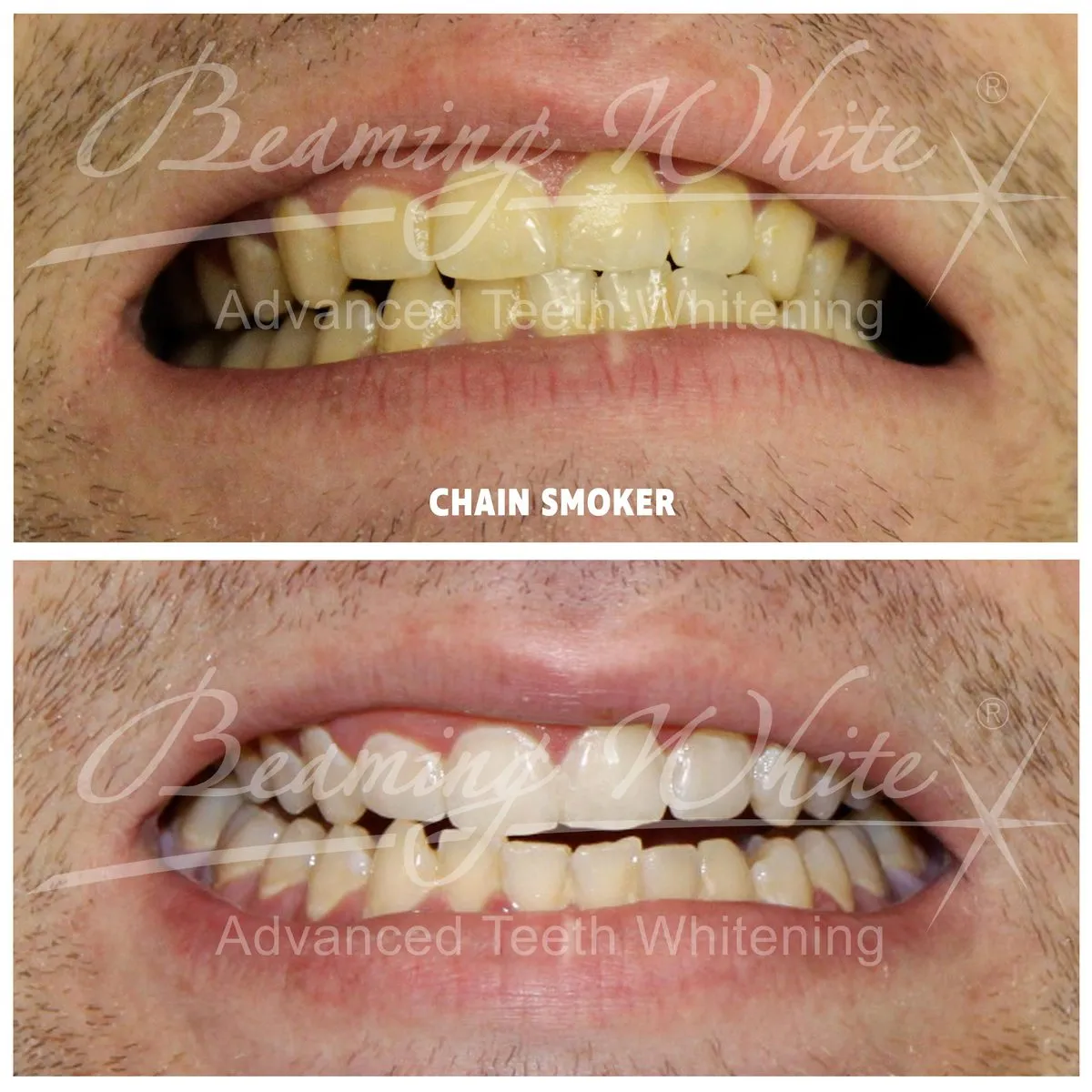 33513 teeth whitening aftercare