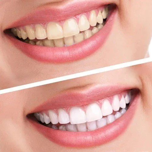 33517 in office teeth whitening