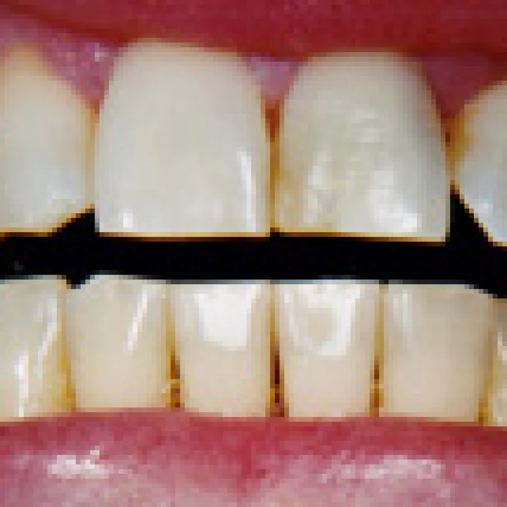 33524 teeth whitening trays