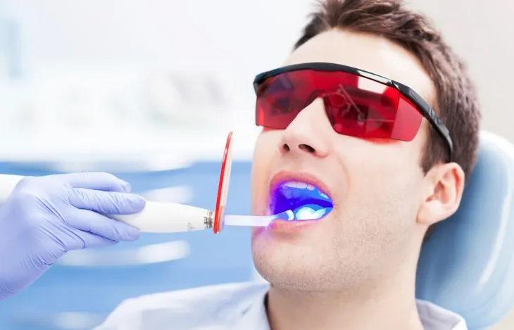 33525 teeth whitening cost