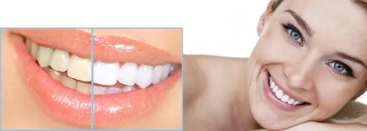 33525 teeth whitening results