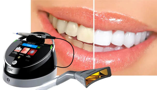 33535 teeth whitening results