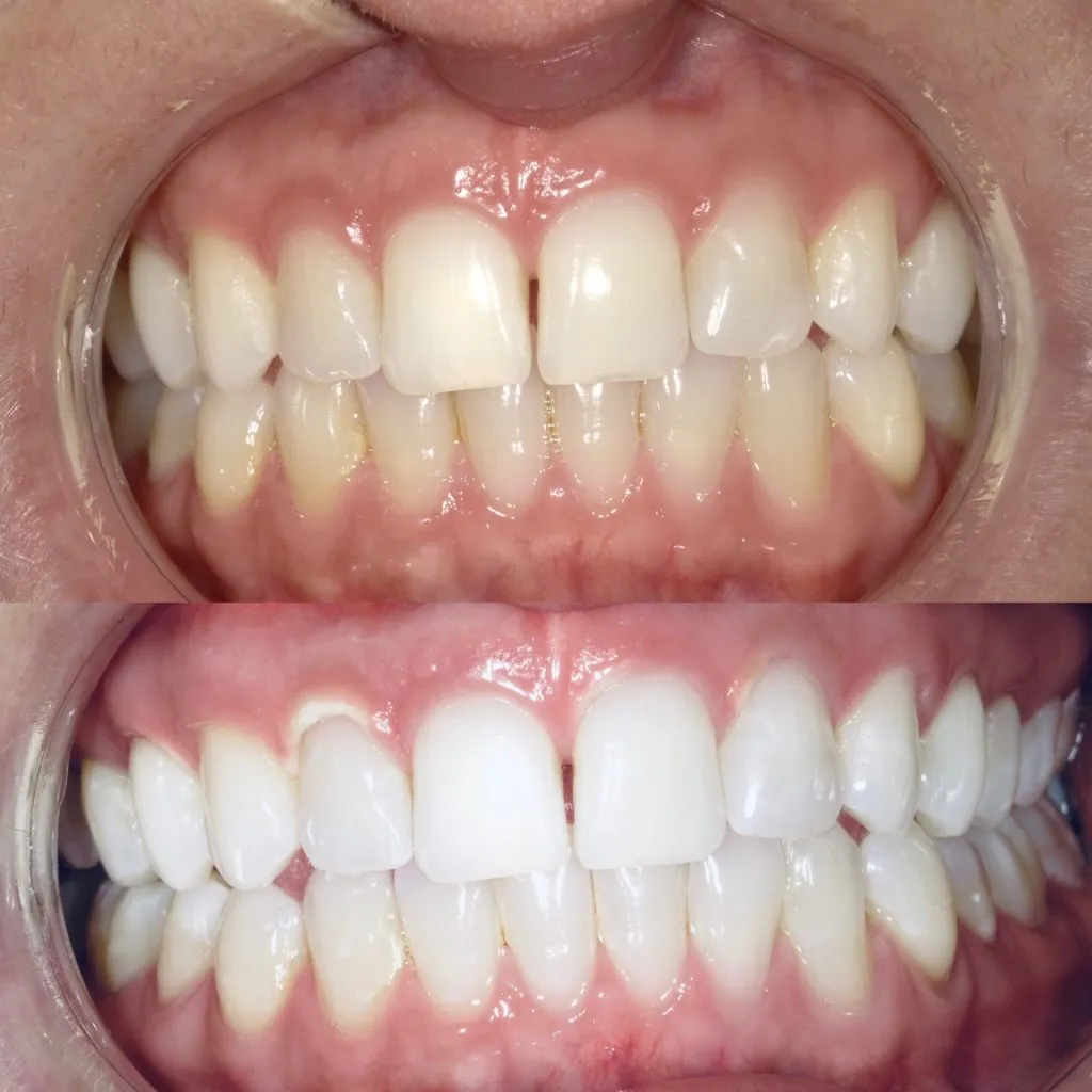 33546 maintaining white teeth
