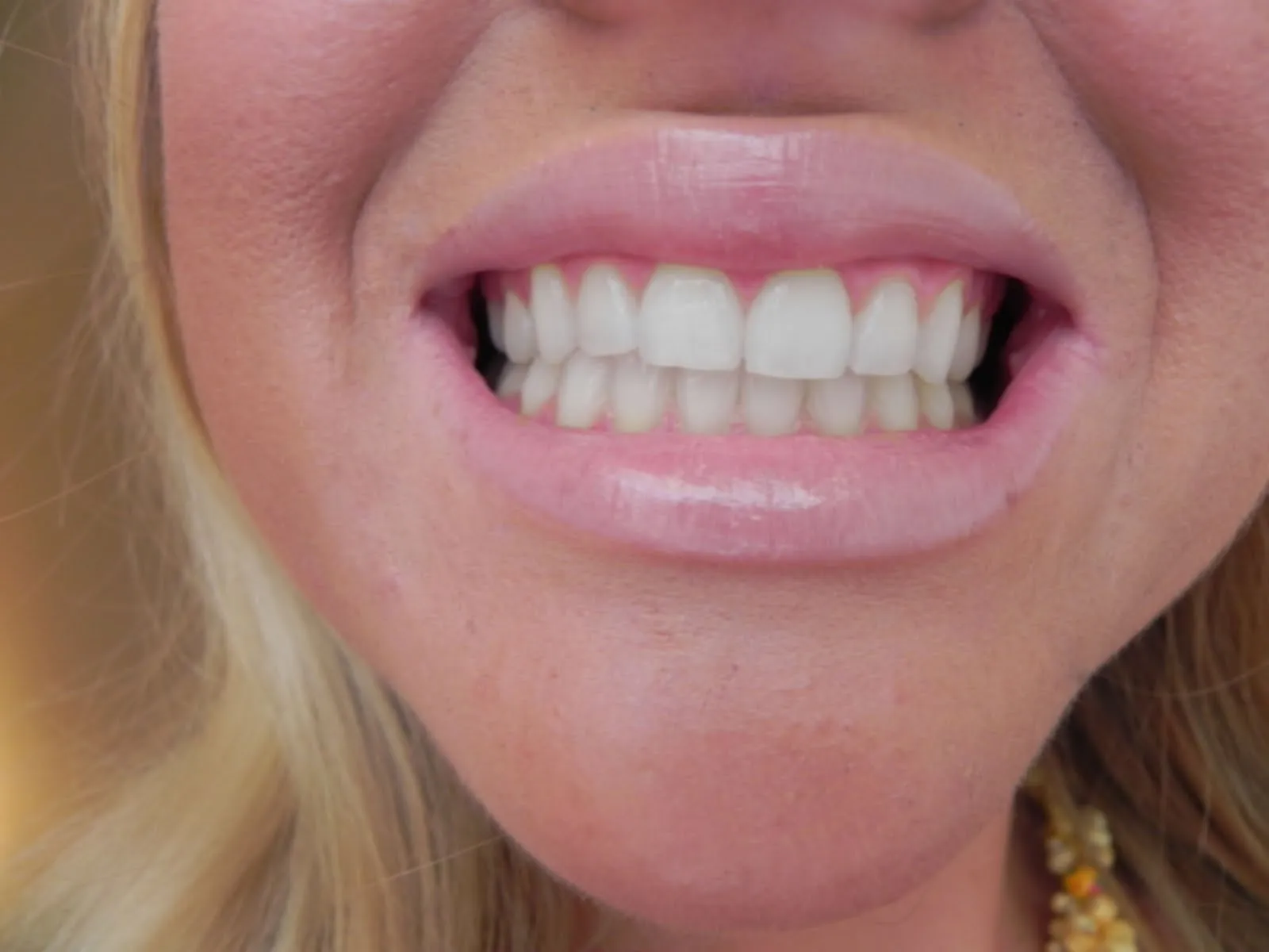 33564 side effects whitening