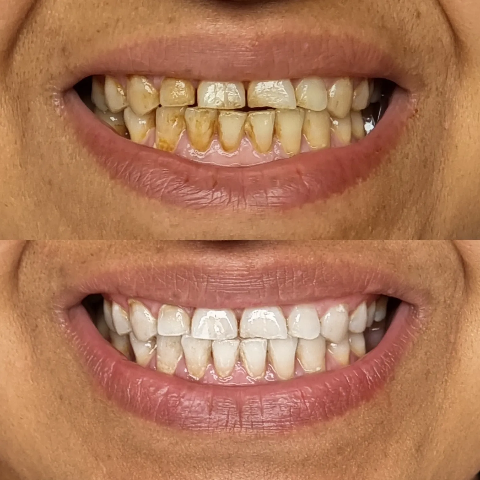 33570 teeth whitening results